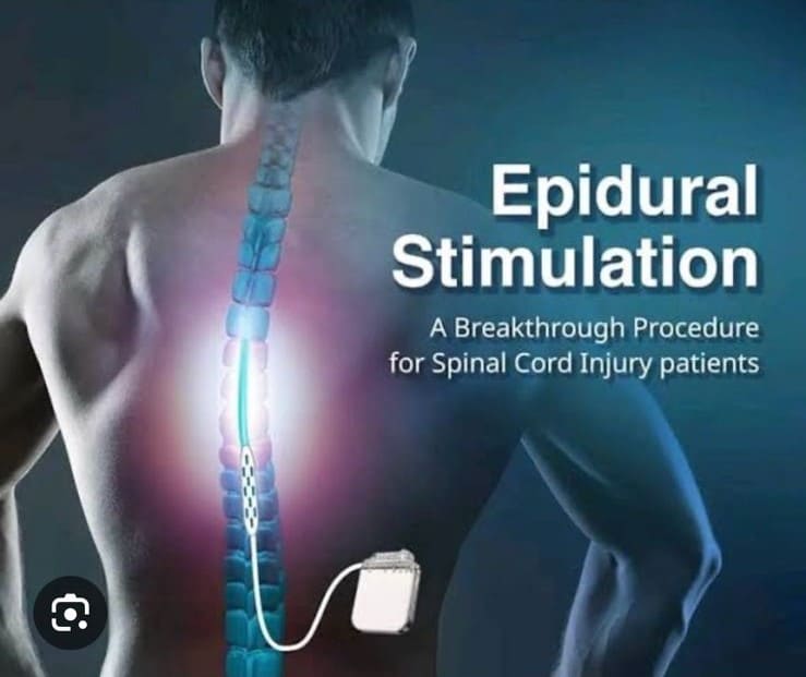 Epidural Stimulation for Spinal Cord Injury